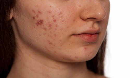 acne 3